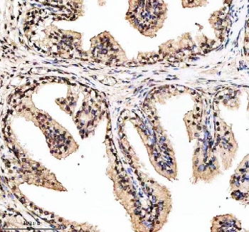 Phospho-ER alpha (pS118) Antibody Prostatic Hyperplasia IHC. Immunohistochemistry of FFPE human prostatic hyperplasia tissue using phospho-ER alpha (pS118) antibody shows HRP-DAB brown nuclear staining in glandular epithelial cells, consistent with phosphorylation at serine 118 and hormonally regulated ESR1 activation, while surrounding stromal elements display lower background; detection was performed with clone EIG-5. HIER: boil tissue sections in pH8 EDTA for 20 min and allow to cool before testing.