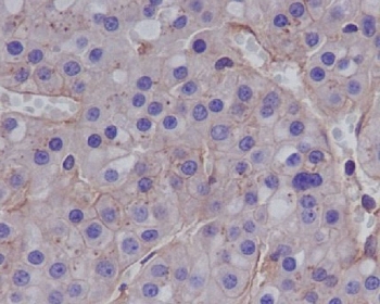 Collagenase 1 Antibody Human Hepatocellular Carcinoma IHC. Immunohistochemistry analysis of FFPE human hepatocellular carcinoma tissue using Collagenase 1 Antibody. Heat induced antigen retrieval was performed by boiling tissue sections in pH 6 citrate buffer for 10â20 minutes prior to staining. Moderate cytoplasmic staining is observed in malignant hepatocytes, consistent with MMP1 expression associated with extracellular matrix remodeling and tumor progression. These results support the use of Collagenase 1 Antibody for studying MMP1 expression, collagen degradation and cancer-associated extracellular matrix remodeling.