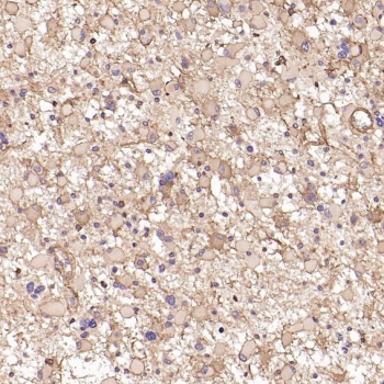Collagenase 1 Antibody Human Astrocytoma IHC. Immunohistochemistry analysis of FFPE human astrocytoma tissue using Collagenase 1 Antibody. Heat induced antigen retrieval was performed by boiling tissue sections in pH 6 citrate buffer for 10â20 minutes prior to staining. Diffuse cytoplasmic staining is observed in tumor cells, consistent with MMP1 expression associated with extracellular matrix remodeling and invasive tumor behavior. These results support the use of Collagenase 1 Antibody for studying MMP1 expression, collagen degradation and cancer-associated tissue remodeling.
