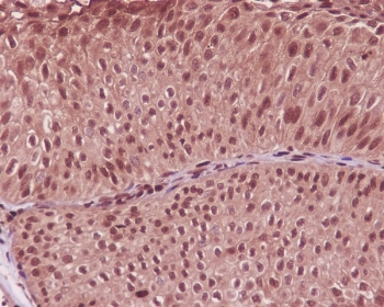IHC staining of FFPE human bladder cancer with GAPDH antibody. HIER: boil tissue sections in pH6, 10mM citrate buffer, for 10-20 min and allow to cool before testing.