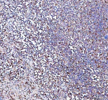 IHC staining of FFPE human intestinal diffuse large B-cell lymphoma tissue with PPA2 antibody. HIER: boil tissue sections in pH8 EDTA for 20 min and allow to cool before testing.