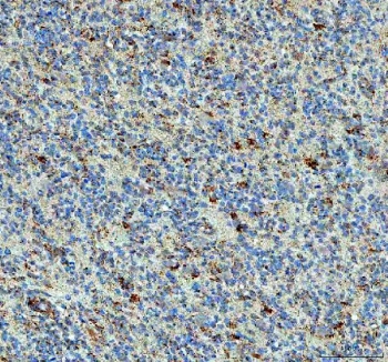 IHC staining of FFPE human glioma tissue with PPA2 antibody. HIER: boil tissue sections in pH8 EDTA for 20 min and allow to cool before testing.