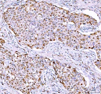 IHC staining of FFPE human breast cancer tissue with PPA2 antibody. HIER: boil tissue sections in pH8 EDTA for 20 min and allow to cool before testing.