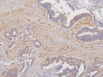 IHC staining of FFPE human colon cancer with RAB3GAP2 antibody. HIER: boil tissue sections in pH6, 10mM citrate buffer, for 20 min and allow to cool before testing.