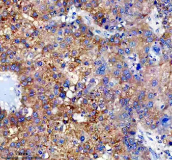 Immunohistochemical staining of FFPE human liver cancer tissue with Cytochrome P450 2E1 antibody, HRP-secondary and DAB substrate. HIER: boil tissue sections in pH8 EDTA for 20 min and allow to cool before testing.