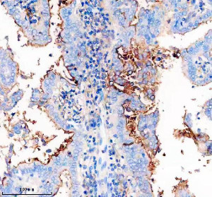 CD54 Antibody DOD-9 in Human Lung Cancer IHC. Immunohistochemistry staining of FFPE human lung cancer tissue with CD54 Antibody clone DOD-9 shows heterogeneous staining, with strong predominantly membranous immunoreactivity in localized tumor regions and weaker staining across much of the surrounding tissue. This Major Rhinovirus Receptor Antibody was applied at 1:50 overnight at 4oC following heat-induced epitope retrieval in EDTA buffer, pH 8.0, and blocking with 10% goat serum. HRP-based detection was performed using DAB chromogen.