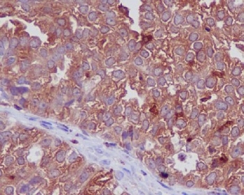 CTSD Antibody Ovarian Carcinoma Immunohistochemistry. IHC staining of FFPE human ovarian cancer with CTSD antibody. HIER: boil tissue sections in pH6, 10mM citrate buffer, for 10-20 min and allow to cool before testing.