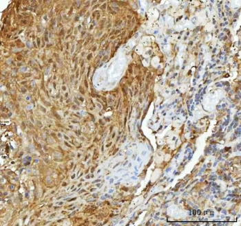 IHC staining of FFPE human lung cancer tissue with HSP90 alpha/beta antibody. HIER: boil tissue sections in pH8 EDTA for 20 min and allow to cool before testing.