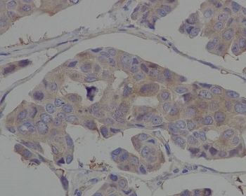 HSP90AA1 Antibody Breast Cancer IHC. Immunohistochemistry staining of FFPE human breast cancer tissue using HSP90AA1 Antibody / Molecular Chaperone Antibody demonstrates moderate cytoplasmic HRP-DAB brown staining within malignant epithelial tumor cells. The staining pattern is consistent with expression of HSP90AA1 (HSP90 alpha), a highly conserved ATP-dependent molecular chaperone that regulates protein folding, stabilization of client proteins, signal transduction, and maintenance of cellular homeostasis. HSP90AA1 supports the activity of numerous signaling molecules involved in cellular proliferation, survival, and adaptation to tumor-associated stress, making it an important target in cancer biology and proteostasis research. HIER was performed by boiling tissue sections in pH 6, 10 mM citrate buffer for 10-20 minutes followed by cooling prior to immunostaining.