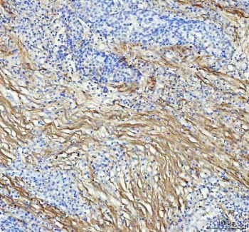 Collagen I Antibody Human Lung Squamous Cell Carcinoma IHC. IHC staining of FFPE human lung squamous cell carcinoma tissue with Collagen I antibody demonstrated strong extracellular staining within the tumor-associated stroma and desmoplastic connective tissue surrounding malignant cell nests. Collagen I is the principal fibrillar collagen of the extracellular matrix and provides structural support while influencing cell adhesion, migration, and tissue remodeling. The prominent stromal staining observed is consistent with the extensive extracellular matrix deposition and remodeling commonly associated with squamous cell carcinoma progression. Heat-induced epitope retrieval was performed by boiling tissue sections in pH 8 EDTA buffer for 10-20 minutes and allowing them to cool before testing. These results support the utility of Collagen I Antibody for studies of extracellular matrix biology, tumor stroma formation, fibrosis, and cancer-associated tissue remodeling.
