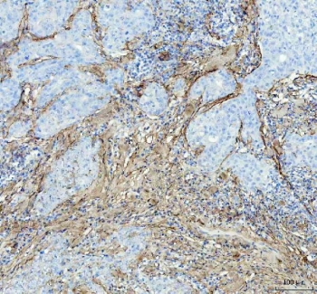 IHC staining of FFPE human breast cancer tissue with Collagen I antibody. HIER: boil tissue sections in pH8 EDTA buffer, for 10-20 min and allow to cool before testing.