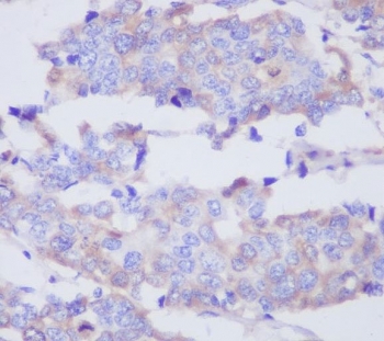 IHC staining of FFPE human breast cancer with MMP2 antibody. HIER: boil tissue sections in pH6, 10mM citrate buffer, for 10-20 min and allow to cool before testing.
