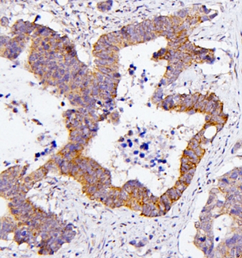 IHC staining of FFPE human colon cancer with CDC42 antibody. HIER: boil tissue sections in pH6, 10mM citrate buffer, for 20 min and allow to cool before testing.