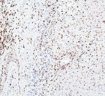 IHC staining of FFPE human testis cancer with CRB1 antibody. HIER: boil tissue sections in pH6, 10mM citrate buffer, for 20 min and allow to cool before testing.