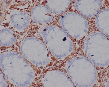 VIM Antibody / Intermediate Filament Assembly Marker Antibody IHC. Immunohistochemistry analysis of FFPE human colon tissue using Vimentin antibody shows strong HRP-DAB brown cytoplasmic staining in stromal and pericryptal mesenchymal cells surrounding colonic glands, with minimal staining in epithelial cells. The staining appears as organized filamentous networks distributed throughout the cytoplasm, consistent with assembled intermediate filament structures. The pattern of Vimentin-positive cells and filament organization supports its role in intermediate filament assembly and cytoskeletal network formation within stromal compartments.
