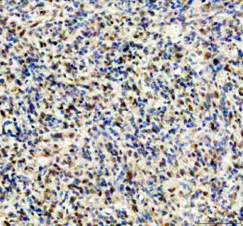 IHC staining of FFPE human glioma tissue with FGF2 antibody, HRP-secondary and DAB substrate. HIER: boil tissue sections in pH8 EDTA for 20 min and allow to cool before testing.