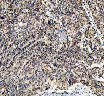 IHC staining of FFPE human liver cancer tissue with FGF2 antibody, HRP-secondary and DAB substrate. HIER: boil tissue sections in pH8 EDTA for 20 min and allow to cool before testing.