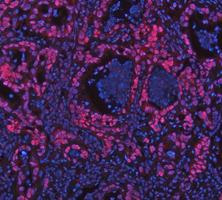 PARP1 Antibody Pancreas Cancer IF. Immunofluorescence analysis of FFPE human pancreas cancer tissue using recombinant rabbit monoclonal PARP1 antibody clone CFD-16. PARP1 staining (red) demonstrates strong nuclear localization within tumor epithelial cells, consistent with the chromatin-associated role of this DNA repair enzyme in genomic stability maintenance and nuclear stress-response signaling pathways in pancreatic carcinoma tissue. Nuclei are counterstained blue with DAPI. Heat-mediated antigen retrieval was performed in pH8 EDTA buffer prior to staining.