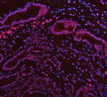 PARP1 Antibody Stomach Cancer IF. Immunofluorescence analysis of FFPE human stomach cancer tissue using recombinant rabbit monoclonal PARP1 antibody clone CFD-16. PARP1 staining (red) demonstrates predominantly nuclear localization within gastric tumor epithelial cells, consistent with the role of this chromatin-associated DNA repair enzyme in genomic surveillance, DNA strand break signaling, and nuclear stress-response pathways in proliferative carcinoma tissue. Nuclei are counterstained blue with DAPI. Heat-mediated antigen retrieval was performed in pH8 EDTA buffer prior to staining.