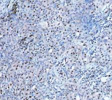 PARP1 Antibody Bladder Cancer IHC. Immunohistochemistry analysis of FFPE human bladder cancer tissue using recombinant rabbit monoclonal PARP1 antibody clone CFD-16. Tumor cell nuclei demonstrate HRP-DAB brown staining consistent with the chromatin-associated localization of PARP1 in DNA damage repair, genomic stability regulation, and nuclear stress-response signaling pathways commonly active in proliferative tumor tissue. Nuclei are counterstained blue. Heat-mediated antigen retrieval was performed in pH8 EDTA buffer prior to staining.