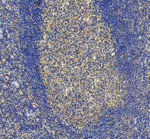 IL-31 Antibody in Human Tonsil Lymphoid Follicles by IHC. Immunohistochemistry of FFPE human tonsil sections using IL-31 Antibody at 2 ug/ml. The image shows heterogeneous cytoplasmic immunoreactivity within the lymphoid tissue, with stronger brown staining in lighter interfollicular and follicular cell populations and comparatively weak staining within densely packed lymphocyte-rich regions. This second field provides a complementary view of IL-31 distribution within human tonsil. HIER was performed using EDTA buffer at pH 8.0, supporting tissue-based validation of the Interleukin 31 Polyclonal Antibody.