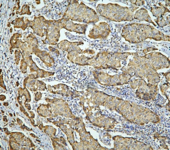 IHC staining of FFPE human breast cancer with LONP1 antibody. HIER: boil tissue sections in pH6, 10mM citrate buffer, for 20 min and allow to cool before testing.