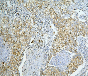 IHC staining of FFPE human lung cancer with LONP1 antibody. HIER: boil tissue sections in pH6, 10mM citrate buffer, for 20 min and allow to cool before testing.