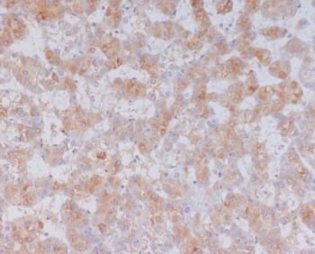 Immunohistochemistry analysis of Serum Amyloid A expression. Serum Amyloid A antibody staining was performed on formalin-fixed, paraffin-embedded human liver cancer tissue, showing DAB-positive cytoplasmic staining in tumor cells, with hematoxylin counterstaining.