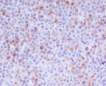 Granzyme B Antibody Human T-Cell Lymphoma IHC. Immunohistochemical staining of FFPE human T-cell lymphoma tissue using Granzyme B Antibody. HIER was performed in pH 6 citrate buffer. An HRP-conjugated secondary antibody with DAB substrate was used for detection. Granzyme B Antibody, a Cytotoxic Lymphocyte Marker Antibody, demonstrates granular cytoplasmic staining in a subset of neoplastic lymphoid cells, consistent with granzyme B expression in cytotoxic T-cell lymphoma.