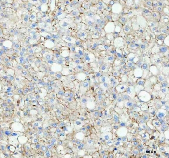 FLOT1 Antibody Human Liver Cancer IHC. Immunohistochemistry staining of FFPE human liver cancer tissue with FLOT1 Antibody. HIER was performed by boiling tissue sections in pH 8 EDTA buffer for 10â20 minutes, followed by cooling prior to staining. The section was incubated with FLOT1 antibody, followed by HRP-secondary and DAB chromogen detection. FLOT1 Antibody / Reggie 2 Antibody demonstrates membrane and cytoplasmic staining consistent with Flotillin 1 expression and supports studies of lipid raft biology, membrane organization, vesicle trafficking and cell signaling regulation.