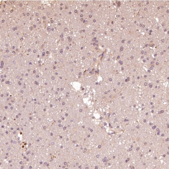 IHC staining of FFPE human glioblastoma tissue with HAPLN1 antibody at 1:50. HIER: boil tissue sections in pH6 citrate buffer for 20 min and allow to cool before testing.