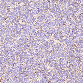 GLUT1 Antibody immunohistochemistry analysis in human thymoma tissue. FFPE human thymoma section shows HRP-DAB brown membranous and cytoplasmic staining in tumor epithelial cells, consistent with GLUT1 (SLC2A1) localization in metabolically active tumor cell populations. Surrounding stromal components display minimal background staining. The section was stained using GLUT1 antibody at 1:200 dilution.
