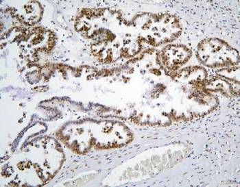 IHC staining of FFPE human ovarian cancer with BHC80 antibody. HIER: boil tissue sections in pH6, 10mM citrate buffer, for 20 min and allow to cool before testing.