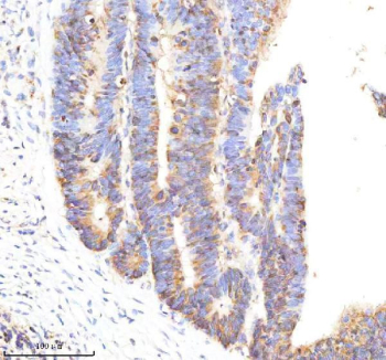 Tissue Factor Antibody Colon Cancer IHC. Immunohistochemistry analysis of FFPE human colon cancer tissue using Tissue Factor antibody. Tumor epithelial cells demonstrate membranous and cytoplasmic HRP-DAB brown staining consistent with the surface-associated localization of Tissue Factor / CD142 in coagulation signaling, inflammatory pathway activation, and tumor-associated procoagulant activity within colorectal carcinoma tissue. Nuclei are counterstained blue. Heat-induced epitope retrieval was performed using EDTA buffer, pH8.0, prior to staining.