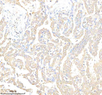 Tissue Factor Antibody Lung Cancer IHC. Immunohistochemistry analysis of FFPE human lung cancer tissue using Tissue Factor antibody. Tumor epithelial cells demonstrate membranous and cytoplasmic HRP-DAB brown staining consistent with the surface-associated localization of Tissue Factor / F3 / CD142 in coagulation pathway activation, inflammatory signaling, and tumor-associated prothrombotic activity within pulmonary carcinoma tissue. Nuclei are counterstained blue. Heat-induced epitope retrieval was performed using EDTA buffer, pH8.0, prior to staining.