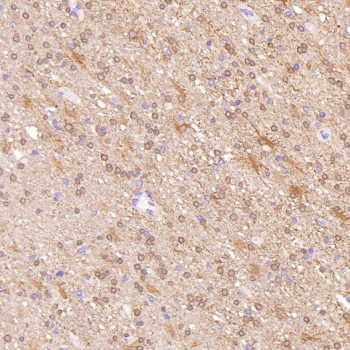 Immunohistochemistry of Glutamine Synthetase Antibody CCH-7 in human glioblastoma. Formalin-fixed, paraffin-embedded human glioblastoma tissue demonstrates diffuse cytoplasmic HRP-DAB brown staining in tumor cells, consistent with Glutamate-ammonia ligase (GLUL) expression in astrocytic lineage-derived cells. Background stromal elements show comparatively lower signal. The antibody was used at a 1:250 dilution for paraffin-embedded tissue analysis.