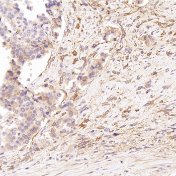 Immunohistochemistry of Glutamine Synthetase Antibody CCH-7 in human prostate carcinoma. Formalin-fixed, paraffin-embedded human prostate cancer tissue demonstrates cytoplasmic HRP-DAB brown staining in malignant epithelial cells, with variable intensity across tumor regions. Adjacent stromal components show comparatively weaker signal. Staining is consistent with Glutamate-ammonia ligase (GLUL) cytoplasmic localization. The antibody was applied at a 1:250 dilution for paraffin-embedded tissue analysis.