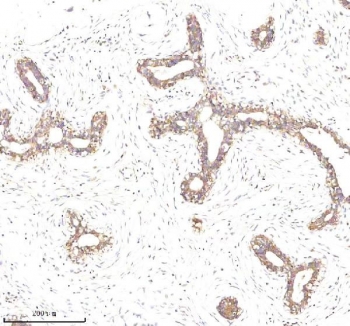 EpCAM Antibody Breast Cancer Glandular IHC. Immunohistochemistry staining of FFPE human breast cancer tissue using EpCAM Antibody demonstrates selective membranous HRP-DAB brown staining within neoplastic epithelial cells forming glandular and ductal tumor structures, while the surrounding stromal compartment remains largely negative. The staining pattern is consistent with expression of Epithelial Cell Adhesion Molecule (EPCAM/CD326), a cell surface glycoprotein involved in epithelial cell adhesion, maintenance of tissue architecture, and epithelial differentiation. Strong membrane-associated staining highlights the epithelial phenotype of the tumor cells and supports the established use of EpCAM as a marker of epithelial-derived malignancies. The observed immunoreactivity is useful for studies of tumor cell identification, epithelial lineage characterization, and breast cancer biology. HIER: boil tissue sections in pH 8 EDTA buffer for 20 minutes and allow to cool before testing.