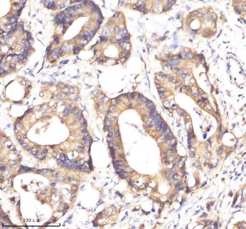 EpCAM Antibody Colon Adenocarcinoma IHC. Immunohistochemistry staining of FFPE human colon cancer tissue using EpCAM Antibody demonstrates strong membranous and circumferential HRP-DAB brown staining within neoplastic glandular epithelial cells. The staining pattern is consistent with expression of Epithelial Cell Adhesion Molecule (EPCAM/CD326), a cell surface glycoprotein that plays important roles in epithelial cell adhesion, tissue organization, and maintenance of epithelial identity. Prominent membrane localization outlines the gland-forming architecture of the tumor and highlights the epithelial origin of the malignant cells. The observed immunoreactivity is consistent with the established expression of EpCAM in colorectal adenocarcinomas and supports its use as a marker for epithelial differentiation, tumor cell detection, and characterization of epithelial-derived malignancies. HIER: boil tissue sections in pH 8 EDTA buffer for 20 minutes and allow to cool before testing.