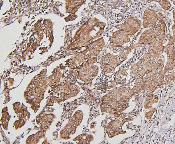 IHC staining of FFPE human breast cancer with BAK1 antibody. HIER: boil tissue sections in pH6, 10mM citrate buffer, for 20 min and allow to cool before testing.