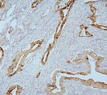 MMP1 Antibody Human Intestinal Cancer IHC. Immunohistochemistry analysis of FFPE human intestinal cancer tissue using MMP1 Antibody / Interstitial Collagenase Antibody. Heat induced antigen retrieval was performed by boiling tissue sections in pH 6 citrate buffer for 20 minutes prior to staining. Strong cytoplasmic and membranous staining is observed in malignant epithelial cells, consistent with MMP1 expression in tumors undergoing extracellular matrix remodeling. These results support the use of MMP1 Antibody / Interstitial Collagenase Antibody for studying interstitial collagenase expression, tumor invasion and cancer-associated extracellular matrix remodeling.