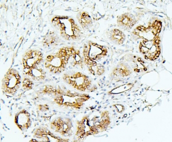 MMP1 Antibody Human Breast Cancer IHC. Immunohistochemistry analysis of FFPE human breast cancer tissue using MMP1 Antibody / Interstitial Collagenase Antibody. Heat induced antigen retrieval was performed by boiling tissue sections in pH 6 citrate buffer for 20 minutes prior to staining. Strong cytoplasmic and membranous staining is observed in malignant epithelial cells, consistent with MMP1 expression associated with extracellular matrix remodeling and tumor progression. These results support the use of MMP1 Antibody / Interstitial Collagenase Antibody for studying interstitial collagenase expression, breast cancer biology and cancer-associated tissue remodeling.