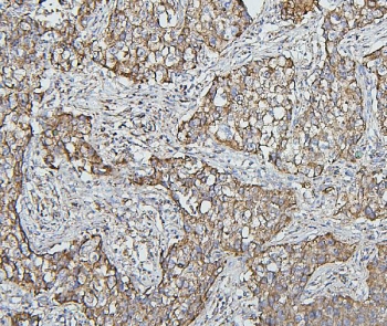 IHC staining of FFPE human lung cancer with Hsp60 antibody. HIER: boil tissue sections in pH6, 10mM citrate buffer, for 20 min and allow to cool before testing.