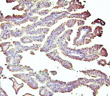 ALDH1A1 Antibody Renal Cancer IHC. Immunohistochemistry analysis of FFPE human renal carcinoma stained with ALDH1A1 Antibody / Cancer Stem Cell and Retinoic Acid Metabolism Marker. Tumor epithelial cells display cytoplasmic and partial membranous HRP-DAB brown staining for Aldehyde dehydrogenase 1 family member A1 / ALDH1A1, consistent with expression of this aldehyde detoxification and retinoic acid metabolism enzyme in renal tumor tissue. Hematoxylin counterstain highlights nuclei in blue. HIER: boil tissue sections in 10 mM citrate buffer, pH6, for 20 min followed by cooling before testing.