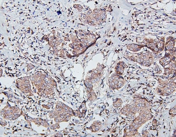 IHC staining of FFPE human breast cancer with SDHB antibody. HIER: boil tissue sections in pH6, 10mM citrate buffer, for 20 min and allow to cool before testing.