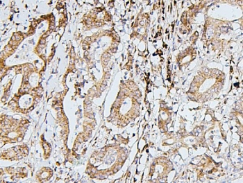 IHC staining of FFPE human intestinal cancer with SDHB antibody. HIER: boil tissue sections in pH6, 10mM citrate buffer, for 20 min and allow to cool before testing.