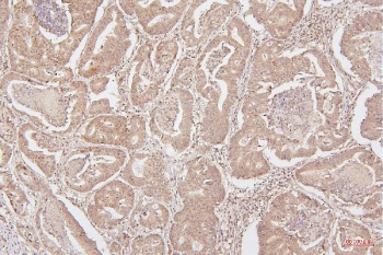 IHC staining of FFPE human intestinal cancer with HMGB1 antibody. HIER: boil tissue sections in pH6, 10mM citrate buffer, for 20 min and allow to cool before testing.