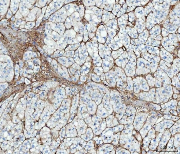 Fibronectin Antibody Adrenocortical Adenoma IHC. Immunohistochemistry staining of FFPE human adrenocortical adenoma tissue with Fibronectin antibody. HIER: boil tissue sections in pH8 EDTA for 20 min and allow to cool before testing.