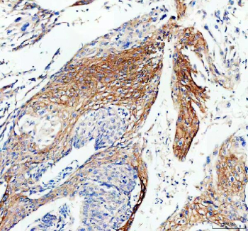 Immunohistochemical staining of FFPE human cervical cancer tissue using Connexin 43 antibody. Staining is observed in tumor epithelial cells. Visualization was performed with an HRP-conjugated secondary antibody and DAB substrate, with hematoxylin counterstaining. Heat-induced epitope retrieval was performed using EDTA buffer (pH 8.0).