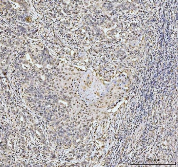 Nucleolin Antibody Rabbit Polyclonal immunohistochemistry analysis of human renal pelvis tissue. Formalin-fixed paraffin-embedded human squamous metaplasia of the renal pelvis stained with Nucleolin Antibody Rabbit Polyclonal. HRP-DAB brown chromogenic staining highlights nuclei of epithelial cells within the metaplastic squamous epithelium, consistent with the expected nuclear and nucleolar localization of Nucleolin / NCL. HIER: boil tissue sections in pH8 EDTA for 20 minutes and allow to cool before testing.